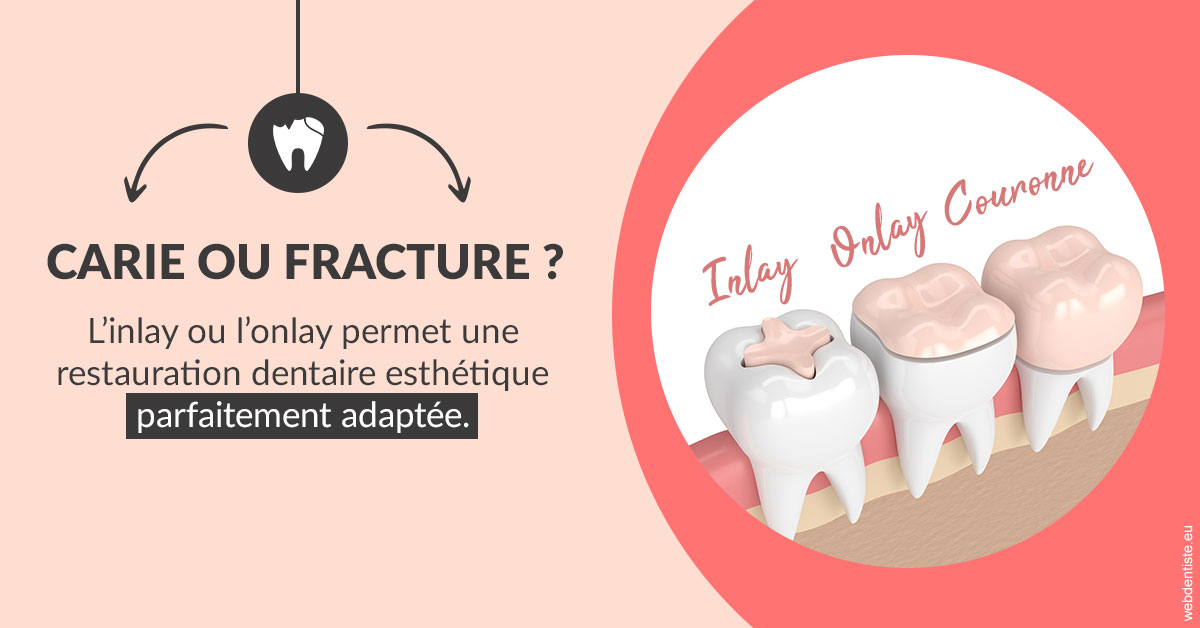 https://dr-bord-julien.chirurgiens-dentistes.fr/T2 2023 - Carie ou fracture 2