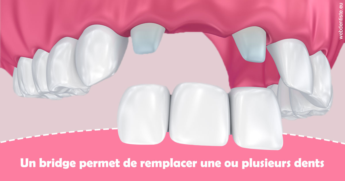 https://dr-bord-julien.chirurgiens-dentistes.fr/Bridge remplacer dents 2