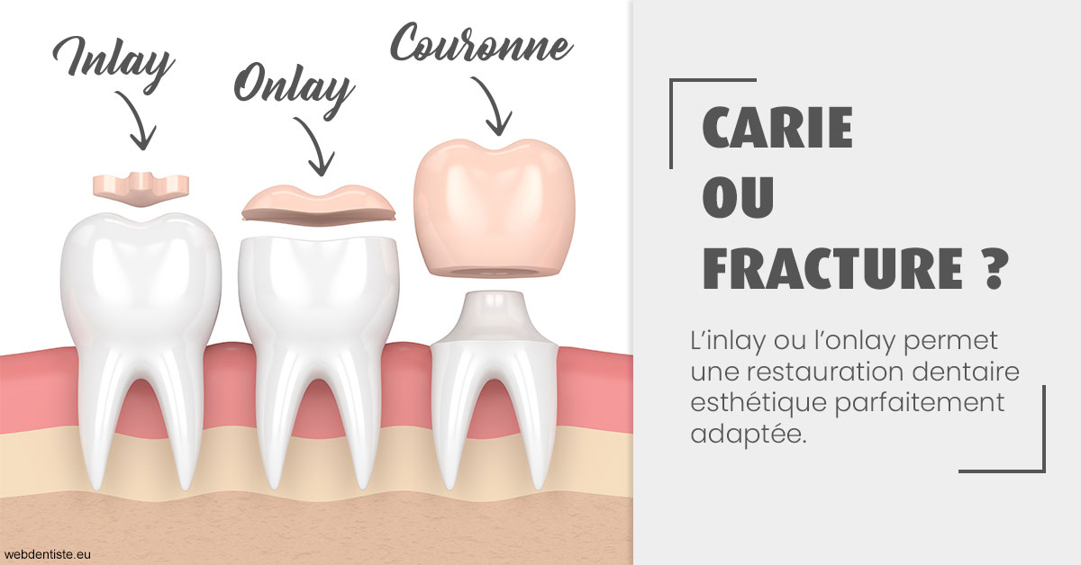 https://dr-bord-julien.chirurgiens-dentistes.fr/T2 2023 - Carie ou fracture 1