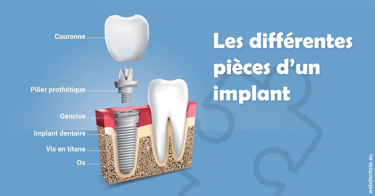 https://dr-bord-julien.chirurgiens-dentistes.fr/Les différentes pièces d’un implant 1